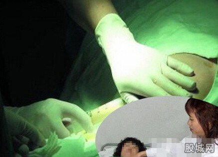 產婦隆胸后炸裂