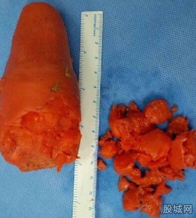 男子將蘿卜捅入肛門