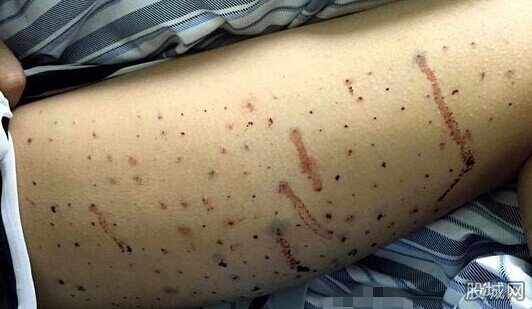 女孩腿上扎100個(gè)窟窿眼