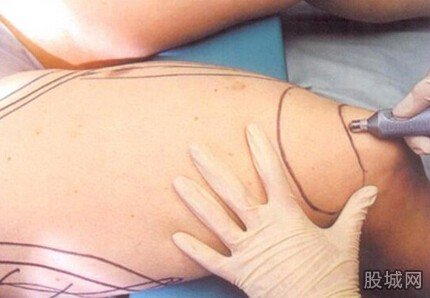 女孩為減肥腿上扎100個(gè)窟窿眼