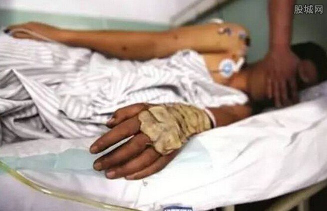 男子被馬蜂蜇百處致死